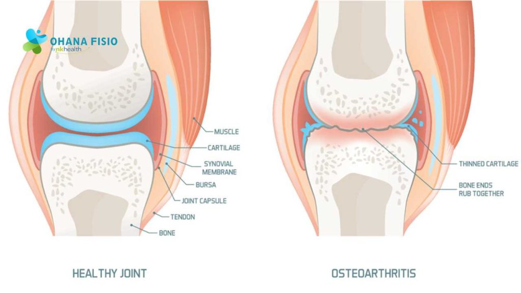 Gejala Osteoarthritis Lutut 