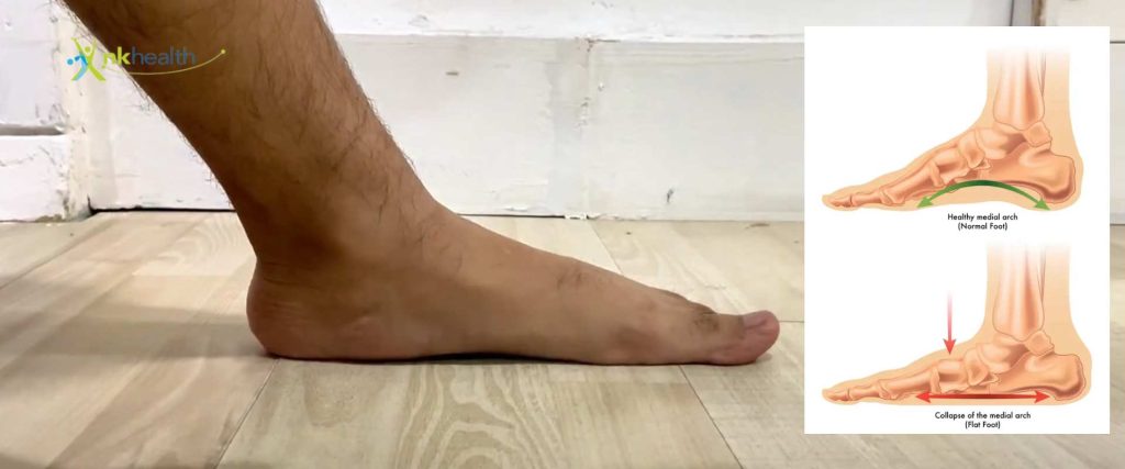fisioterapi kaki datar