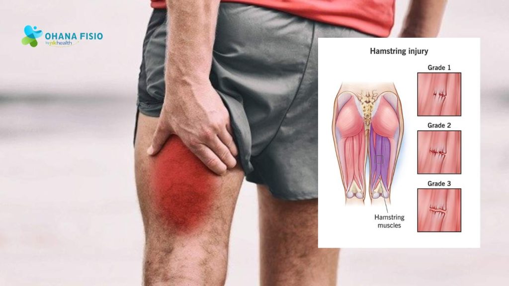 Cara Cepat Menyembuhkan Cedera Otot Hamstring