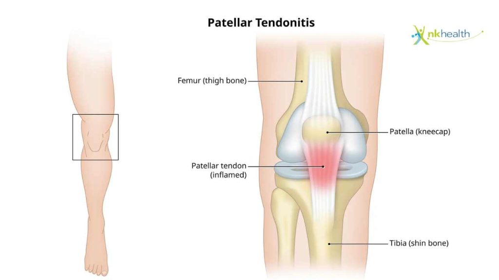 Penyembuhan Cedera Tendon Lutut