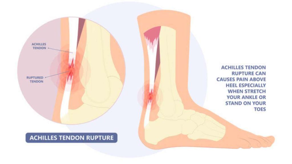 tendon achilles putus