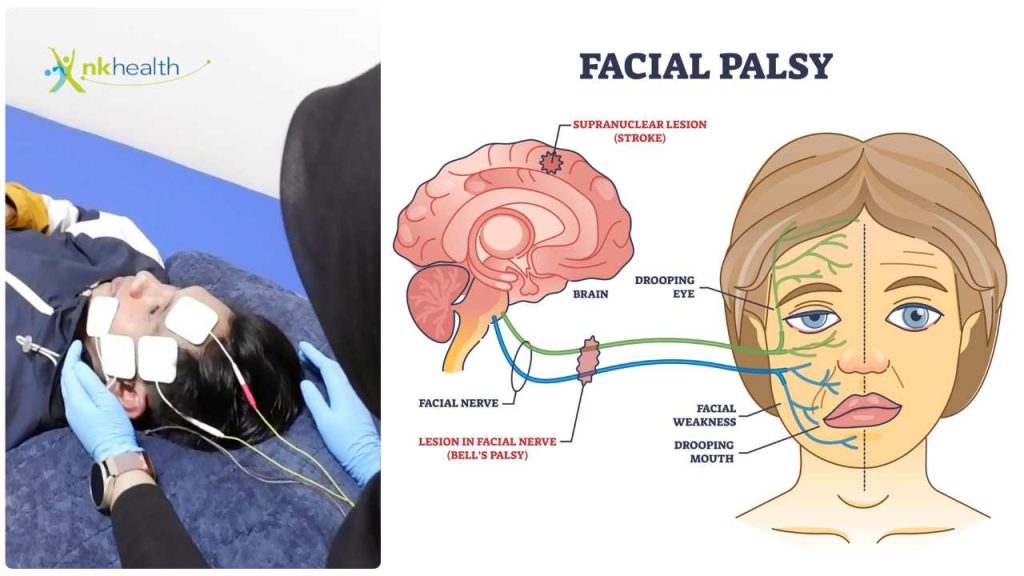 cara penyembuhan bell's palsy